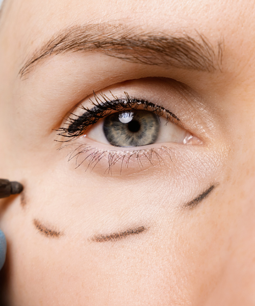 Blepharoplasty And Temple Lift