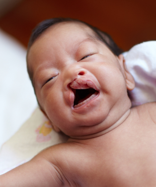 Cleft Palate