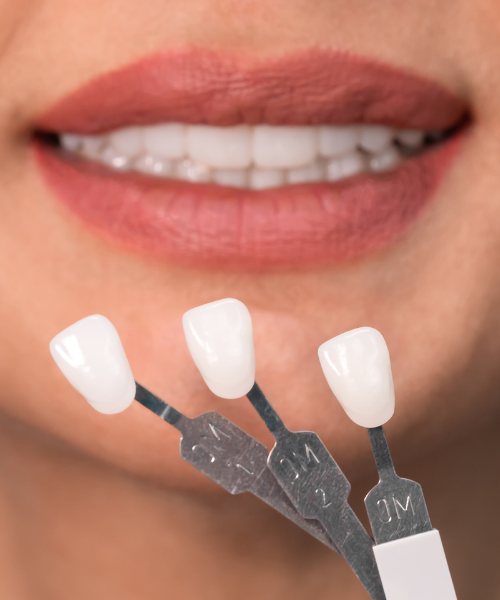 Dental Laminates