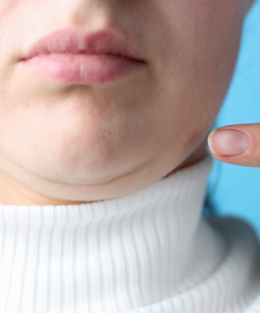 Double Chin Surgery