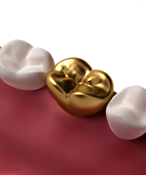 Gold Tooth Crown