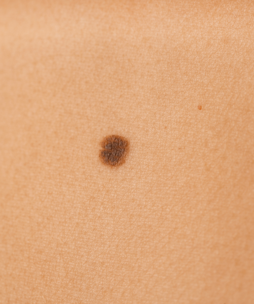 Laser Removal Of Moles And Warts