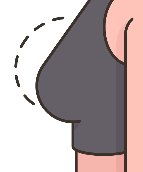 Mammoplasty