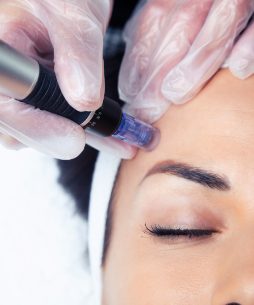 Microneedling