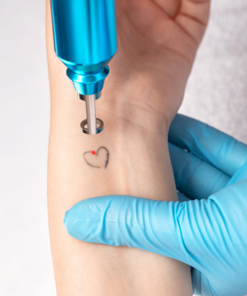 Tattoo Removal