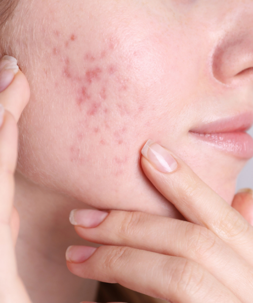 Treatment Of Scars Stitches And Acne