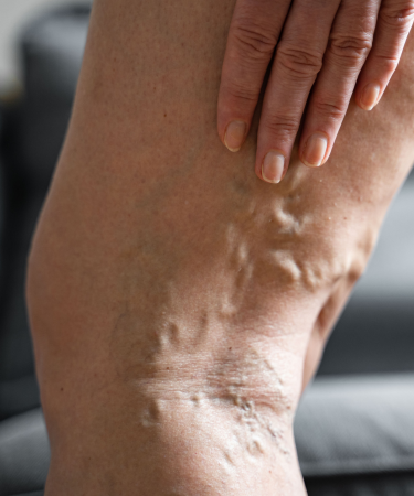 Varicose Veins